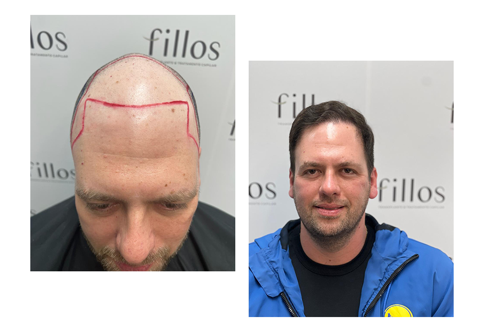 antes--e--depois-Fillos-Transplate-capilar