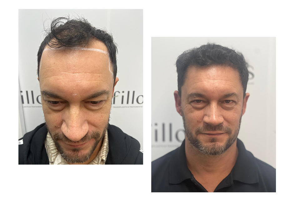 antes-e-depois-Fillos-Transplate-capilar