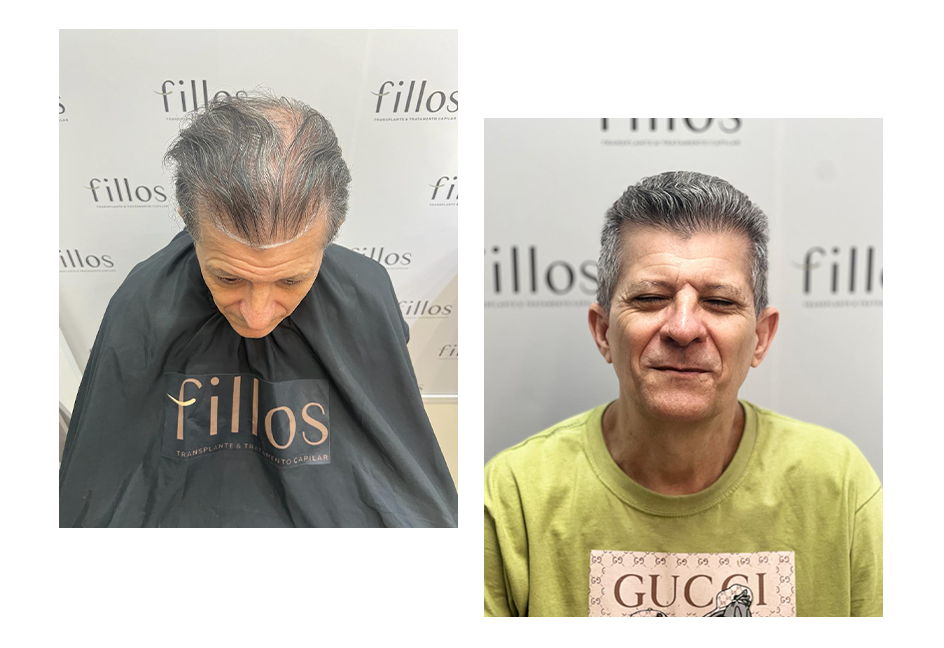 antes--e-depois--Fillos-Transplate-capilar